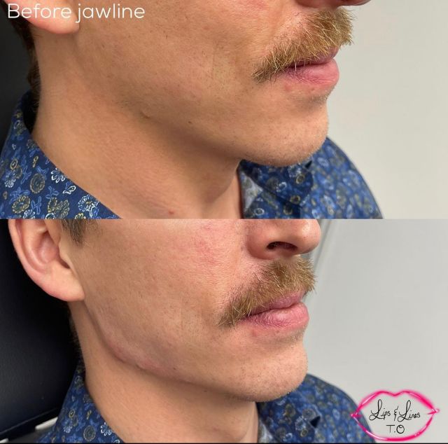 jawline filler small image