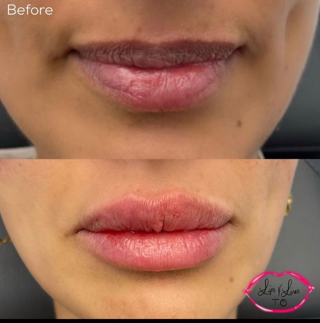 lip filler and reshape small image