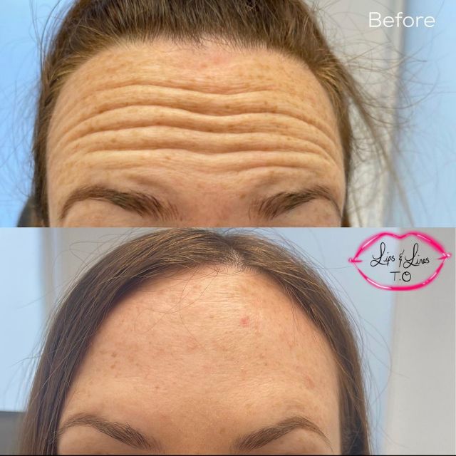 forehead botox small image