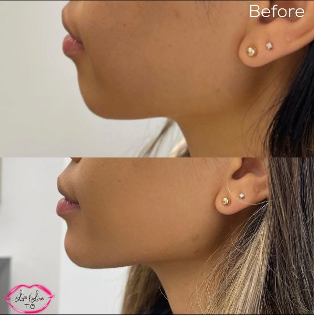 chin filler small image