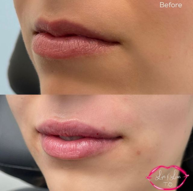 lip filler small image