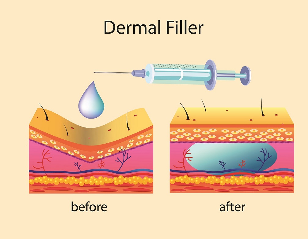 Botox applied to woman