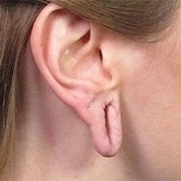 Split earlobe