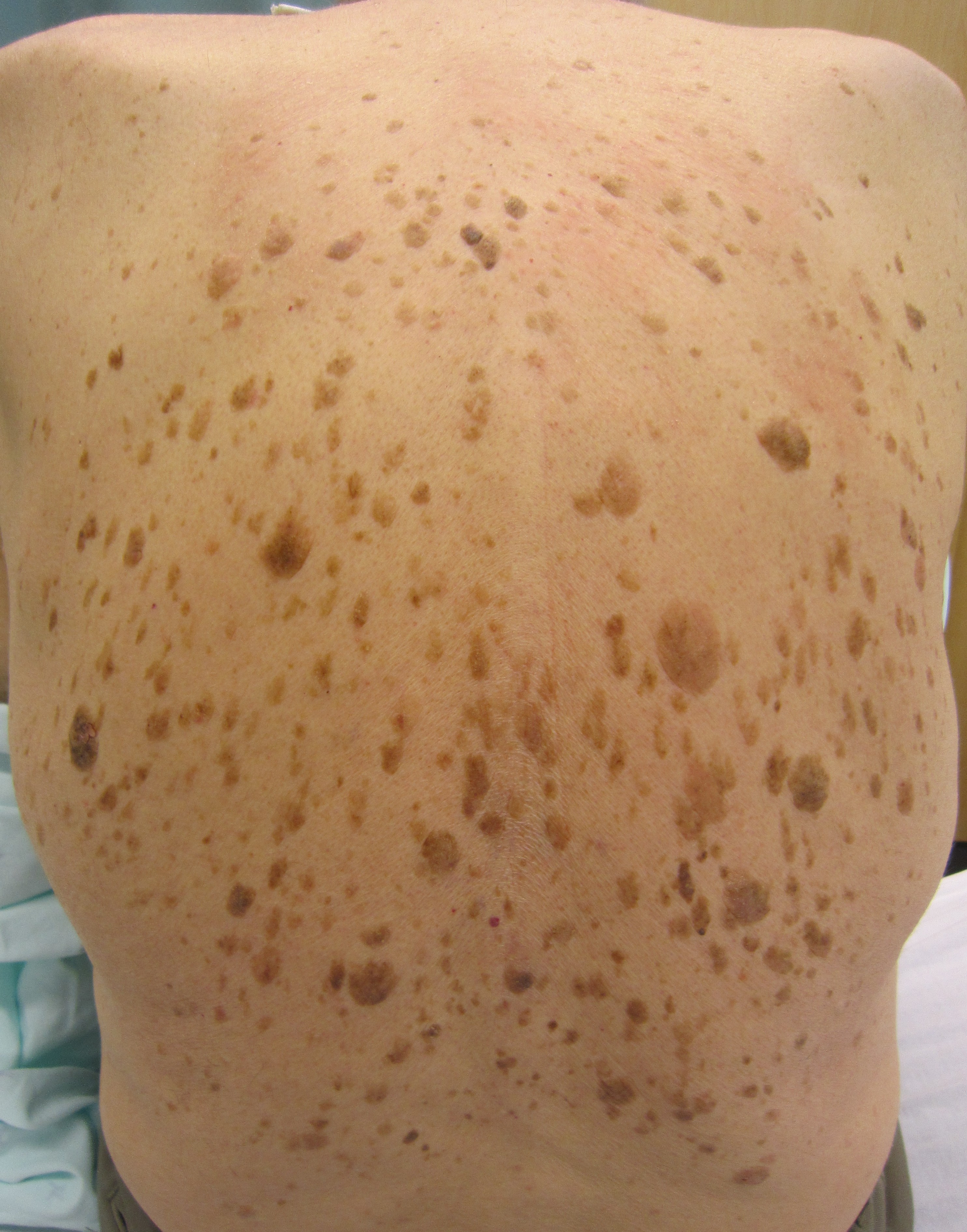 Seborrheic Keratoses Image