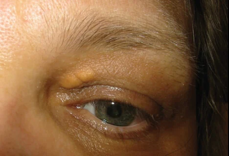 Xanthelasma Image